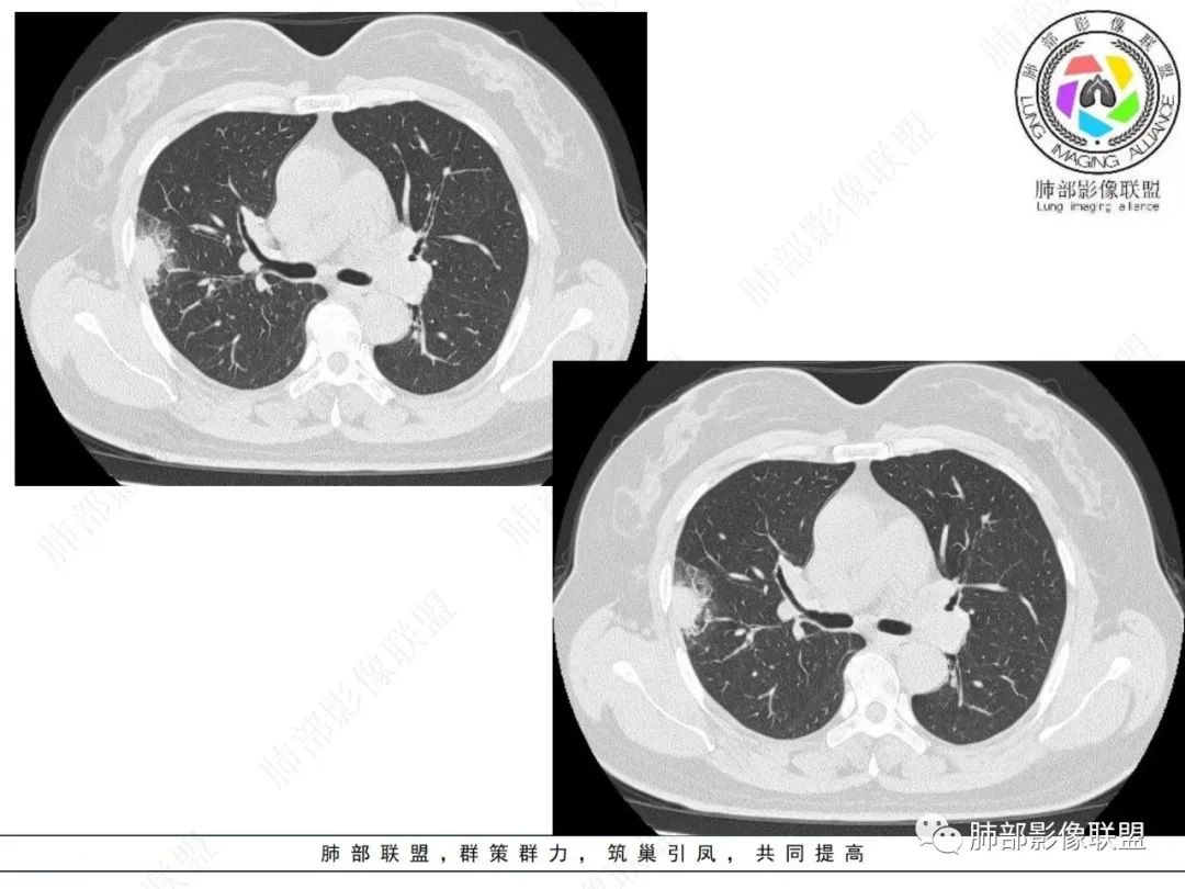 影像PPT - 【病例】粘液腺癌与隐球菌的鉴别诊断-10 影像PPT - 【病例】粘液腺癌与隐球菌的鉴别诊断-10