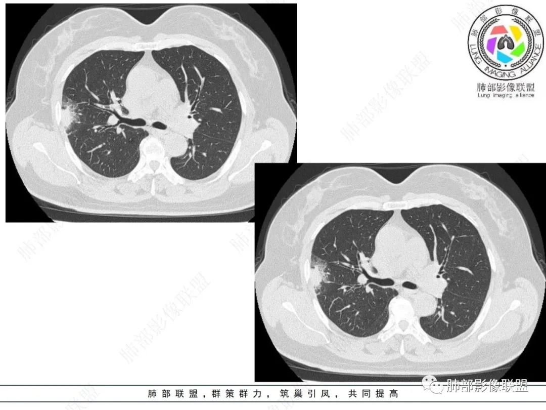 影像PPT - 【病例】粘液腺癌与隐球菌的鉴别诊断-9 影像PPT - 【病例】粘液腺癌与隐球菌的鉴别诊断-9