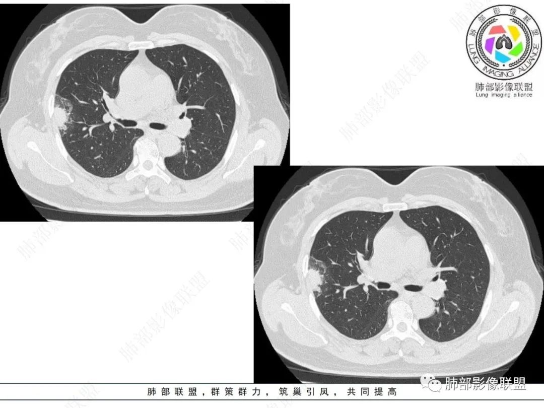 影像PPT - 【病例】粘液腺癌与隐球菌的鉴别诊断-11 影像PPT - 【病例】粘液腺癌与隐球菌的鉴别诊断-11