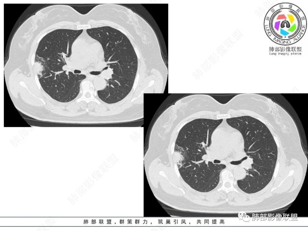 影像PPT - 【病例】粘液腺癌与隐球菌的鉴别诊断-12 影像PPT - 【病例】粘液腺癌与隐球菌的鉴别诊断-12