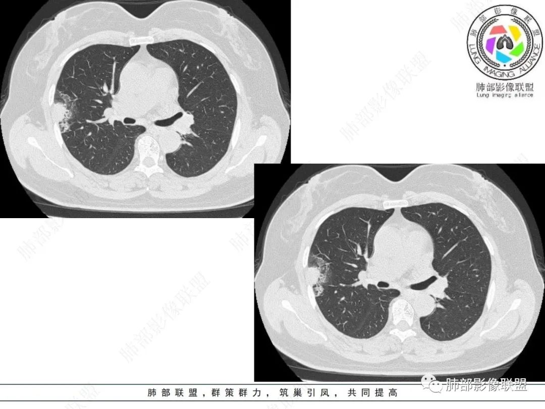 影像PPT - 【病例】粘液腺癌与隐球菌的鉴别诊断-13 影像PPT - 【病例】粘液腺癌与隐球菌的鉴别诊断-13