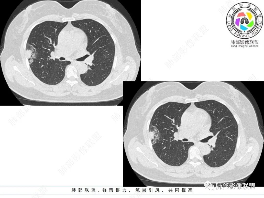 影像PPT - 【病例】粘液腺癌与隐球菌的鉴别诊断-14 影像PPT - 【病例】粘液腺癌与隐球菌的鉴别诊断-14