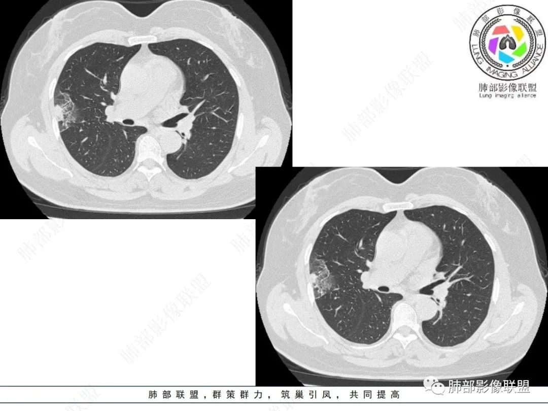 影像PPT - 【病例】粘液腺癌与隐球菌的鉴别诊断-15 影像PPT - 【病例】粘液腺癌与隐球菌的鉴别诊断-15