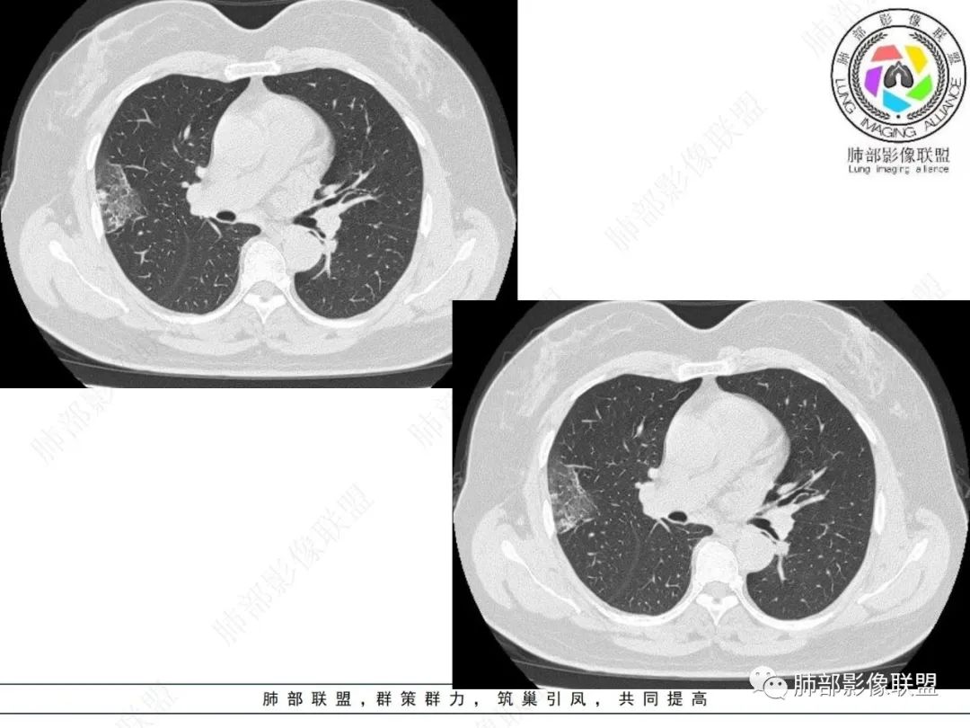 影像PPT - 【病例】粘液腺癌与隐球菌的鉴别诊断-16 影像PPT - 【病例】粘液腺癌与隐球菌的鉴别诊断-16