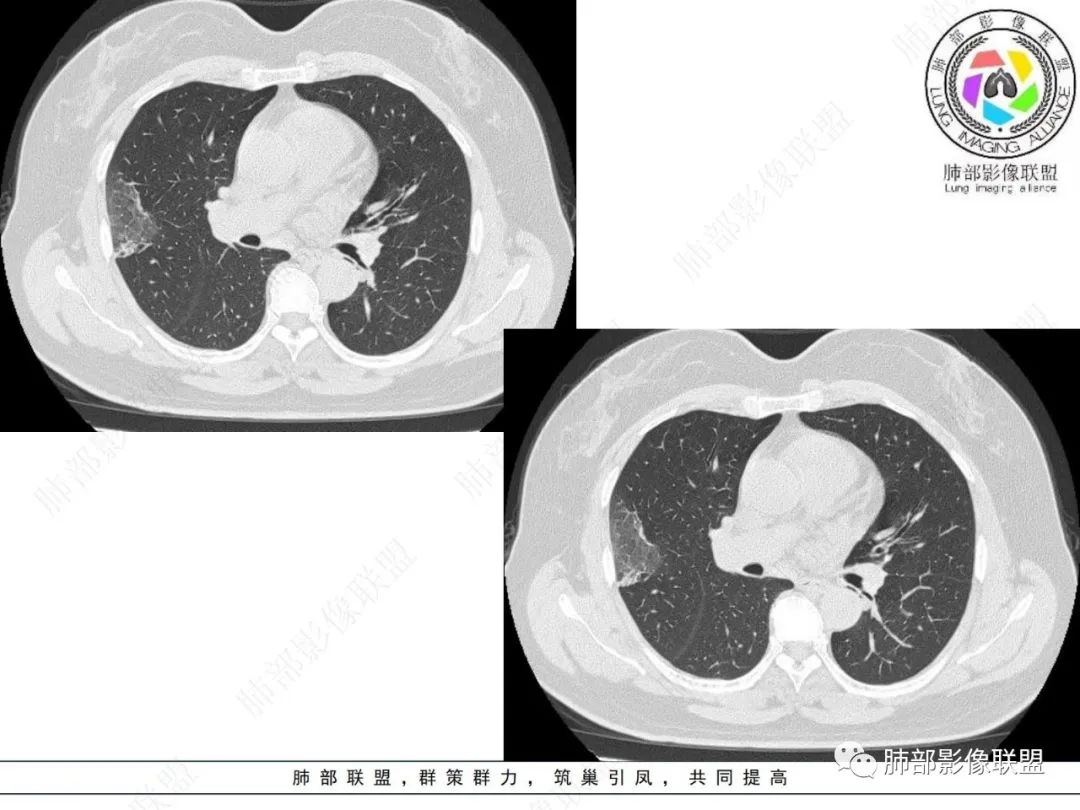 影像PPT - 【病例】粘液腺癌与隐球菌的鉴别诊断-17 影像PPT - 【病例】粘液腺癌与隐球菌的鉴别诊断-17