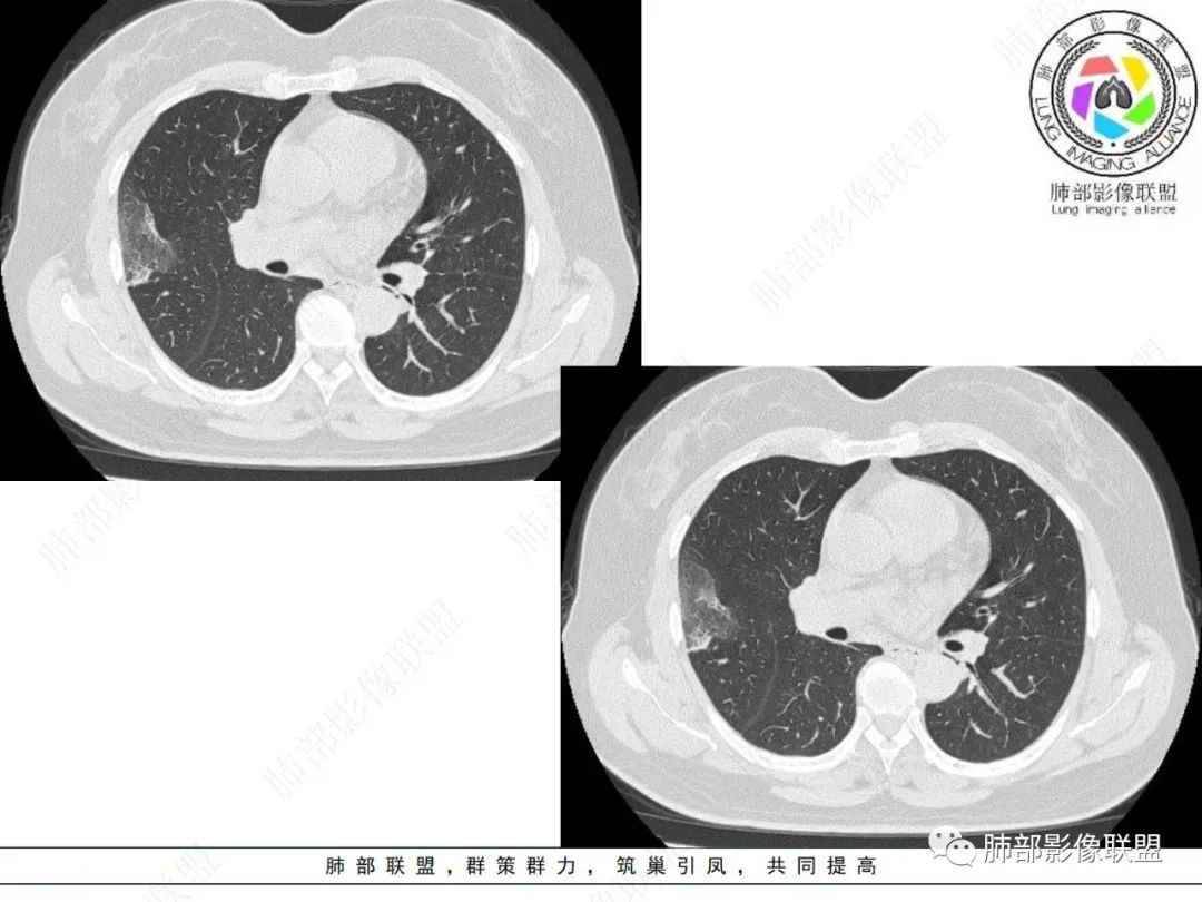 影像PPT - 【病例】粘液腺癌与隐球菌的鉴别诊断-18 影像PPT - 【病例】粘液腺癌与隐球菌的鉴别诊断-18