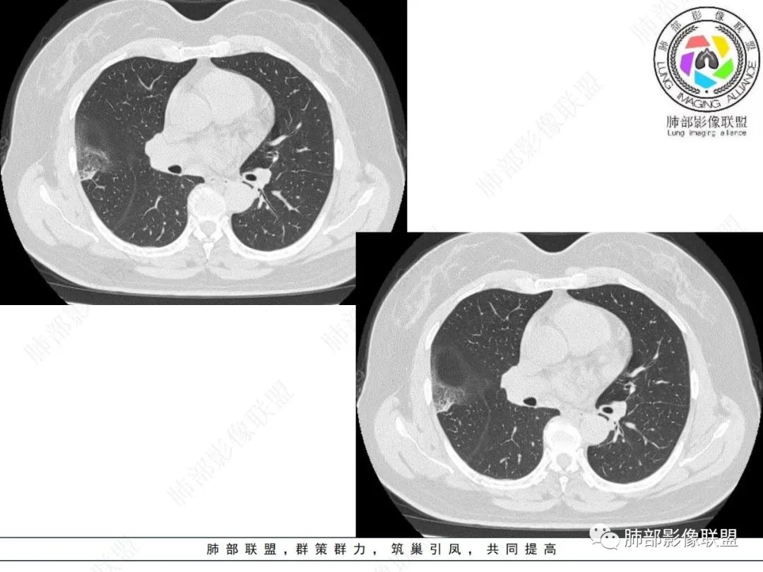 影像PPT - 【病例】粘液腺癌与隐球菌的鉴别诊断-19 影像PPT - 【病例】粘液腺癌与隐球菌的鉴别诊断-19