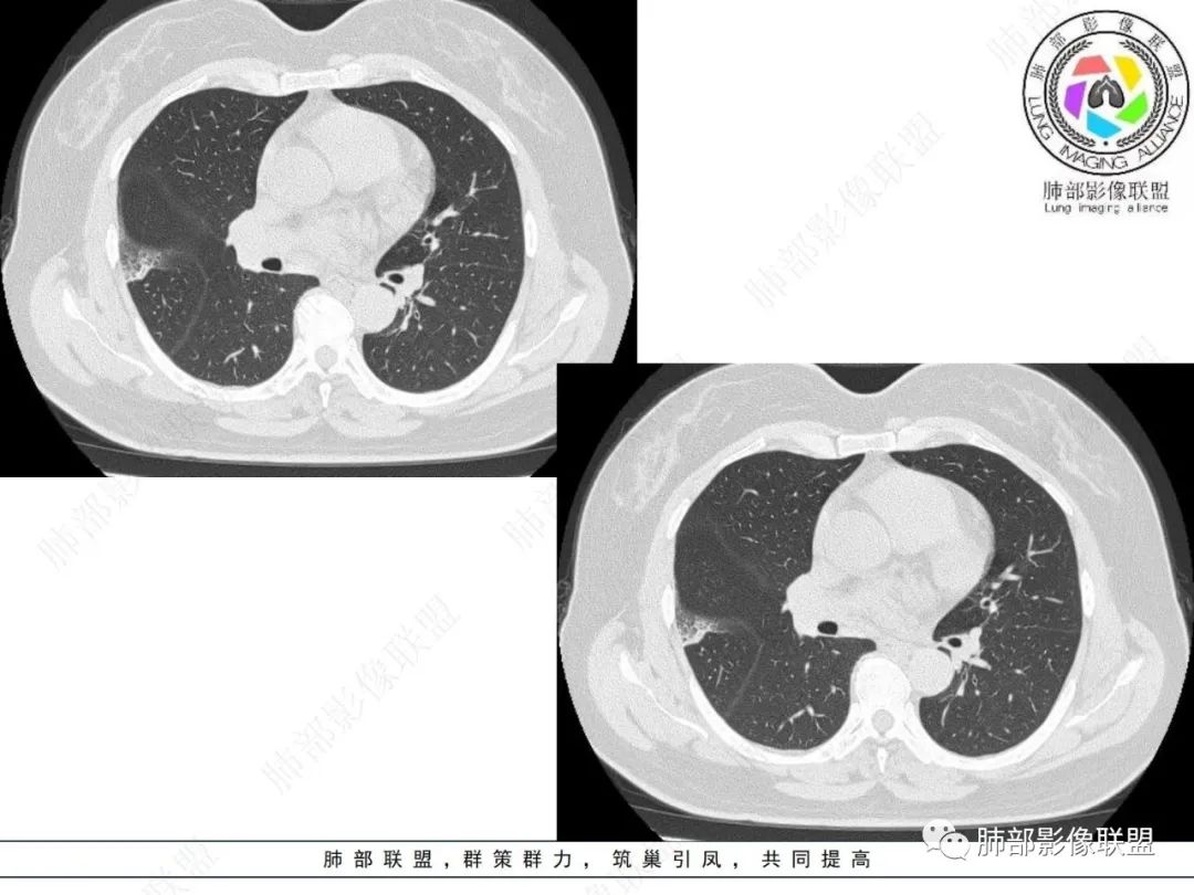 影像PPT - 【病例】粘液腺癌与隐球菌的鉴别诊断-20 影像PPT - 【病例】粘液腺癌与隐球菌的鉴别诊断-20