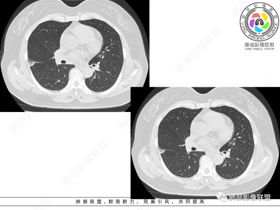 影像PPT - 【病例】粘液腺癌与隐球菌的鉴别诊断-21 影像PPT - 【病例】粘液腺癌与隐球菌的鉴别诊断-21