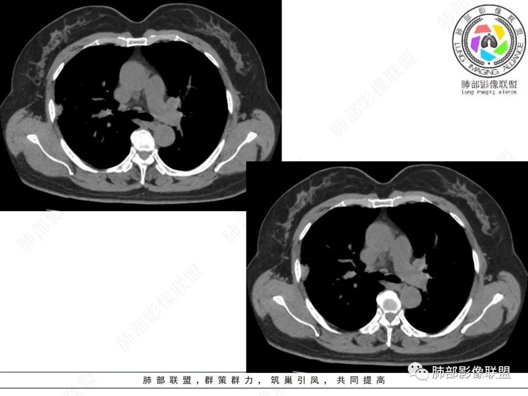 影像PPT - 【病例】粘液腺癌与隐球菌的鉴别诊断-25 影像PPT - 【病例】粘液腺癌与隐球菌的鉴别诊断-25