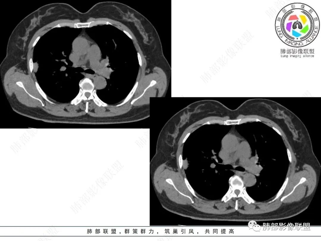影像PPT - 【病例】粘液腺癌与隐球菌的鉴别诊断-26 影像PPT - 【病例】粘液腺癌与隐球菌的鉴别诊断-26