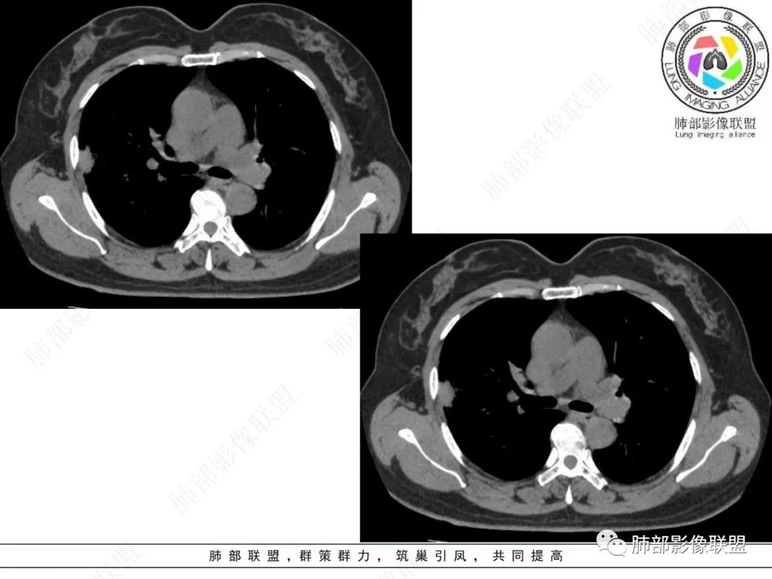 影像PPT - 【病例】粘液腺癌与隐球菌的鉴别诊断-27 影像PPT - 【病例】粘液腺癌与隐球菌的鉴别诊断-27