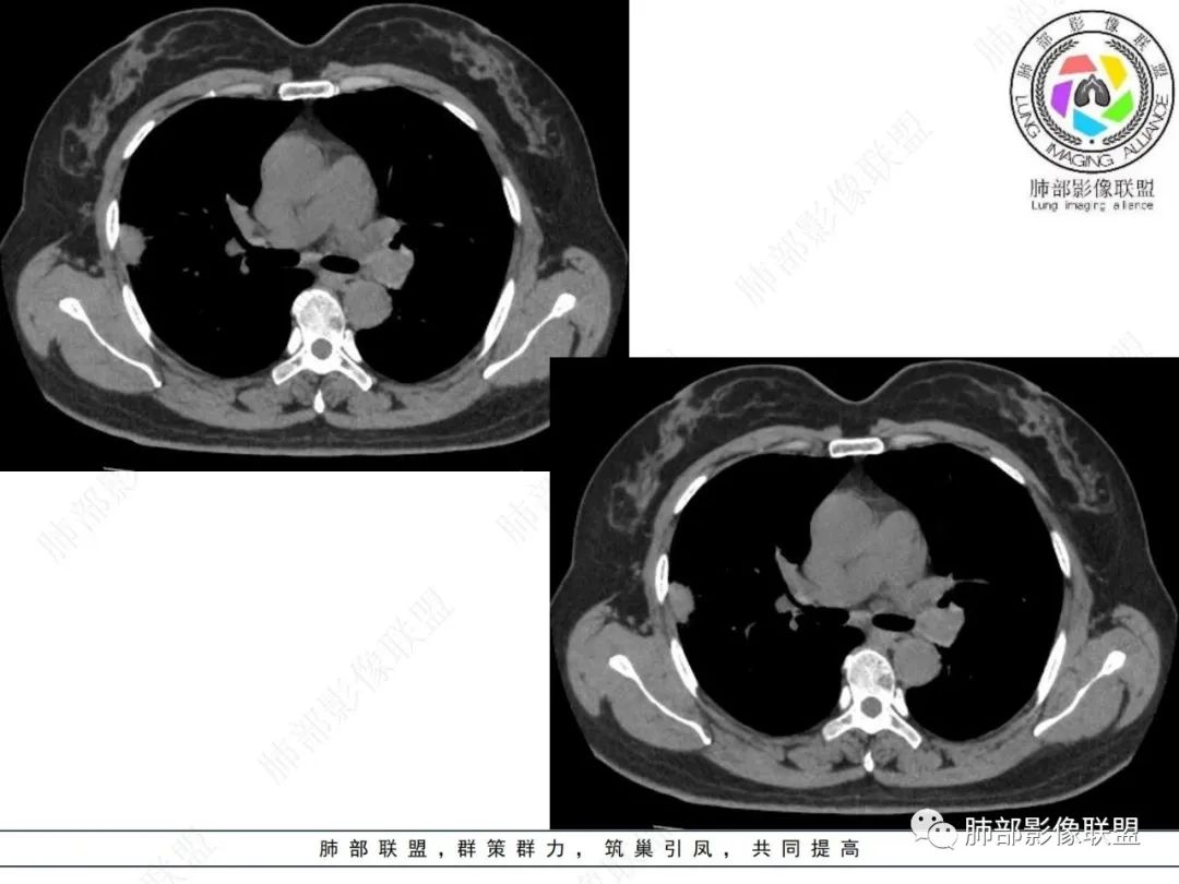 影像PPT - 【病例】粘液腺癌与隐球菌的鉴别诊断-28 影像PPT - 【病例】粘液腺癌与隐球菌的鉴别诊断-28