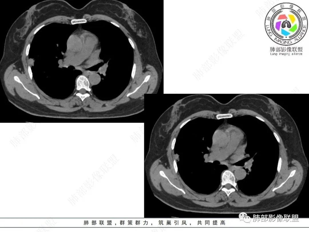 影像PPT - 【病例】粘液腺癌与隐球菌的鉴别诊断-32 影像PPT - 【病例】粘液腺癌与隐球菌的鉴别诊断-32