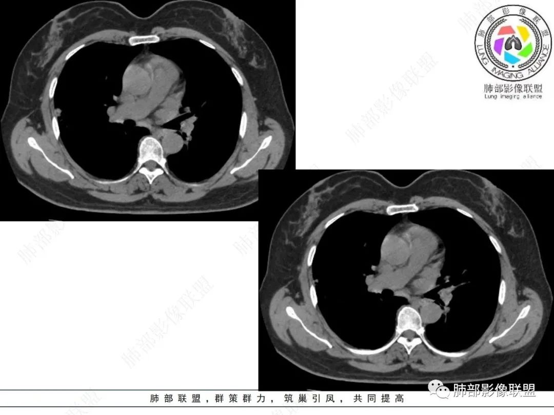 影像PPT - 【病例】粘液腺癌与隐球菌的鉴别诊断-33 影像PPT - 【病例】粘液腺癌与隐球菌的鉴别诊断-33
