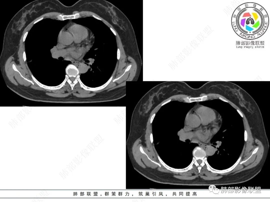 影像PPT - 【病例】粘液腺癌与隐球菌的鉴别诊断-36 影像PPT - 【病例】粘液腺癌与隐球菌的鉴别诊断-36