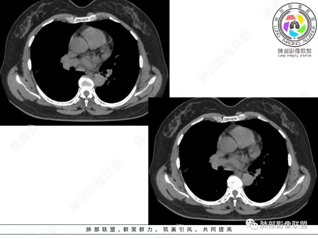 影像PPT - 【病例】粘液腺癌与隐球菌的鉴别诊断-37 影像PPT - 【病例】粘液腺癌与隐球菌的鉴别诊断-37