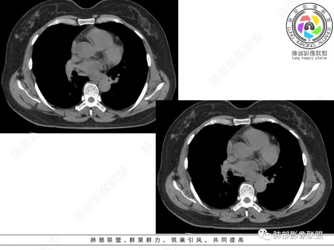 影像PPT - 【病例】粘液腺癌与隐球菌的鉴别诊断-40 影像PPT - 【病例】粘液腺癌与隐球菌的鉴别诊断-40