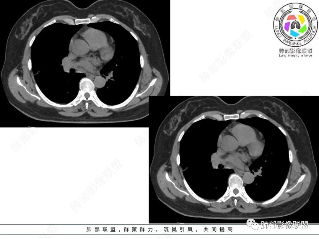 影像PPT - 【病例】粘液腺癌与隐球菌的鉴别诊断-38 影像PPT - 【病例】粘液腺癌与隐球菌的鉴别诊断-38