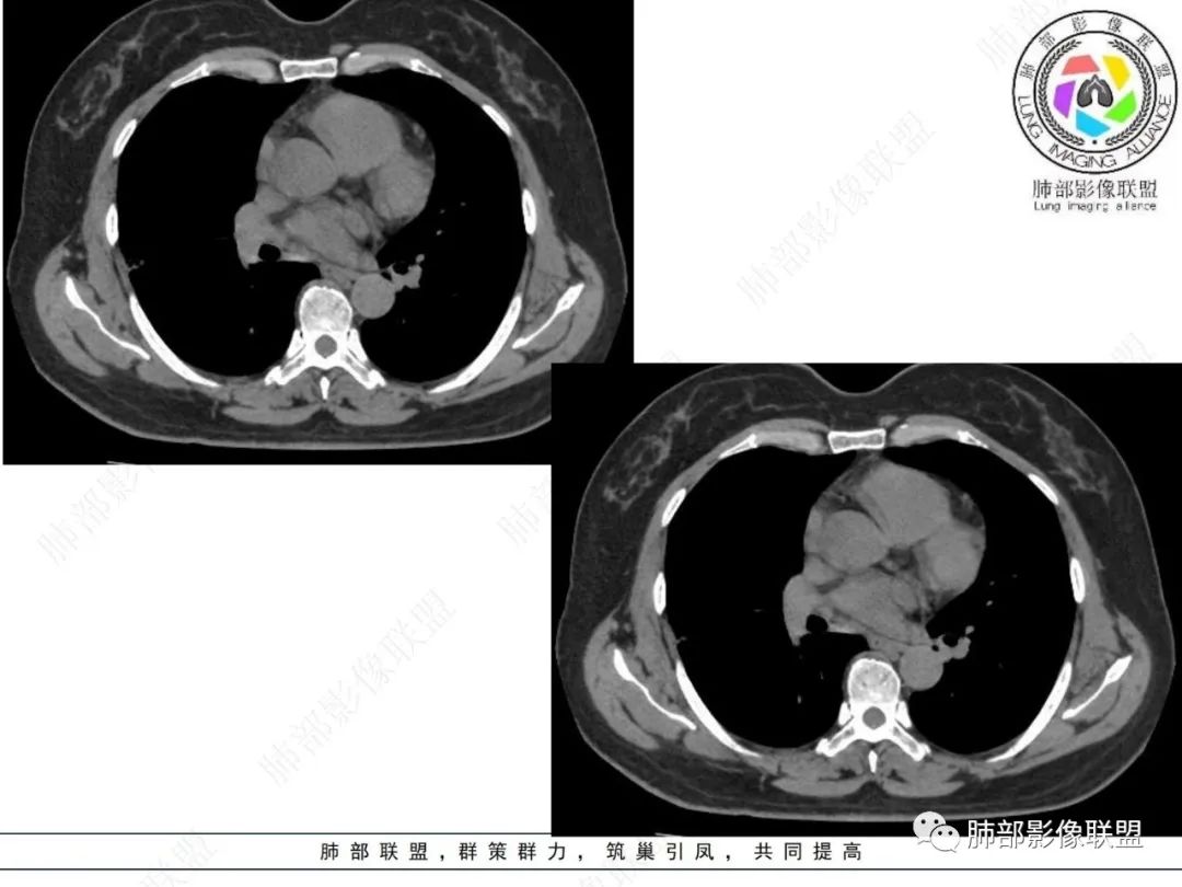 影像PPT - 【病例】粘液腺癌与隐球菌的鉴别诊断-39 影像PPT - 【病例】粘液腺癌与隐球菌的鉴别诊断-39