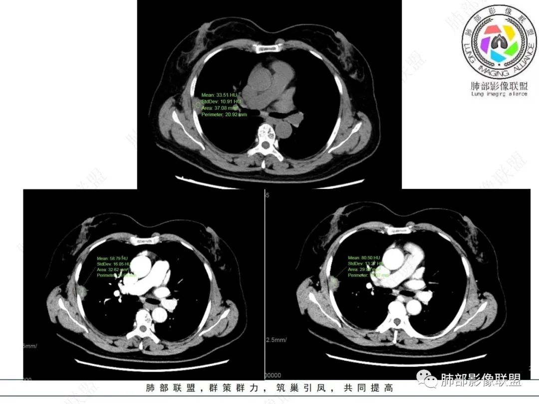影像PPT - 【病例】粘液腺癌与隐球菌的鉴别诊断-41 影像PPT - 【病例】粘液腺癌与隐球菌的鉴别诊断-41
