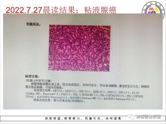 影像PPT - 【病例】粘液腺癌与隐球菌的鉴别诊断-45 影像PPT - 【病例】粘液腺癌与隐球菌的鉴别诊断-45