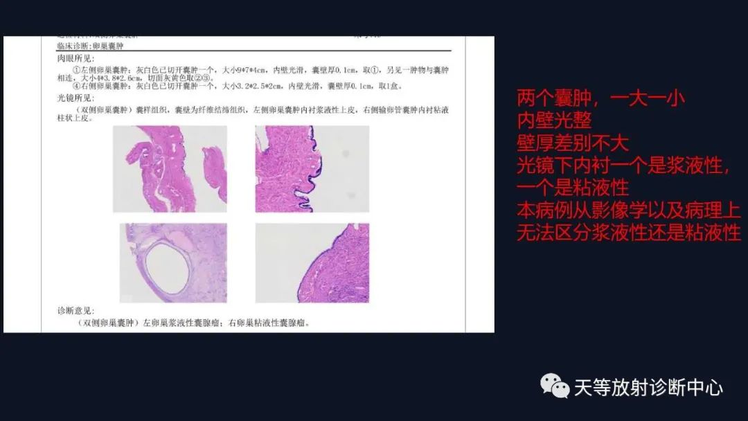 影像PPT - 【病例】卵巢囊腺瘤1例MR影像-18 影像PPT - 【病例】卵巢囊腺瘤1例MR影像-18