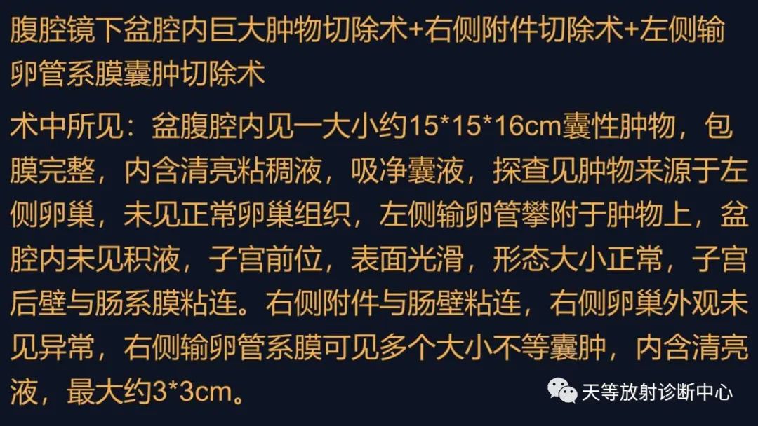 影像PPT - 【病例】卵巢囊腺瘤1例MR影像-17 影像PPT - 【病例】卵巢囊腺瘤1例MR影像-17