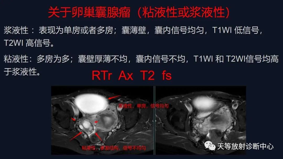 影像PPT - 【病例】卵巢囊腺瘤1例MR影像-25 影像PPT - 【病例】卵巢囊腺瘤1例MR影像-25