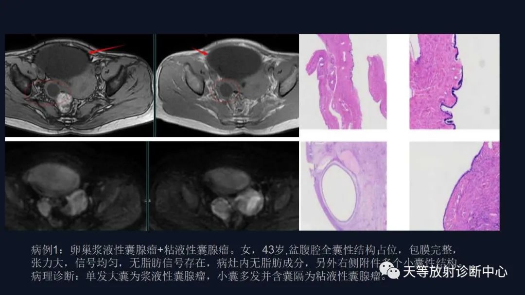 影像PPT - 【病例】卵巢囊腺瘤1例MR影像-26 影像PPT - 【病例】卵巢囊腺瘤1例MR影像-26