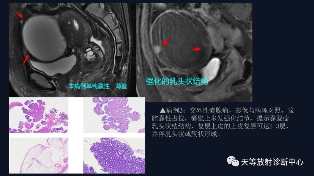 影像PPT - 【病例】卵巢囊腺瘤1例MR影像-29 影像PPT - 【病例】卵巢囊腺瘤1例MR影像-29