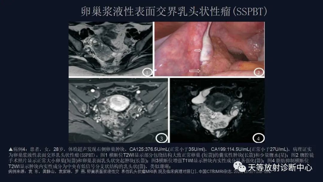 影像PPT - 【病例】卵巢囊腺瘤1例MR影像-30 影像PPT - 【病例】卵巢囊腺瘤1例MR影像-30