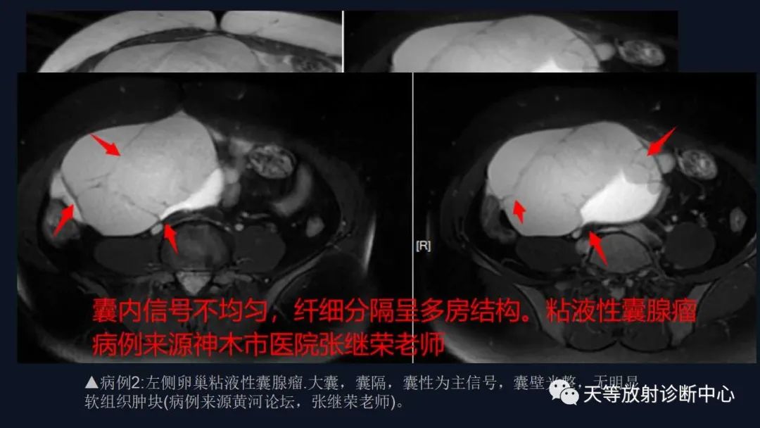 影像PPT - 【病例】卵巢囊腺瘤1例MR影像-27 影像PPT - 【病例】卵巢囊腺瘤1例MR影像-27