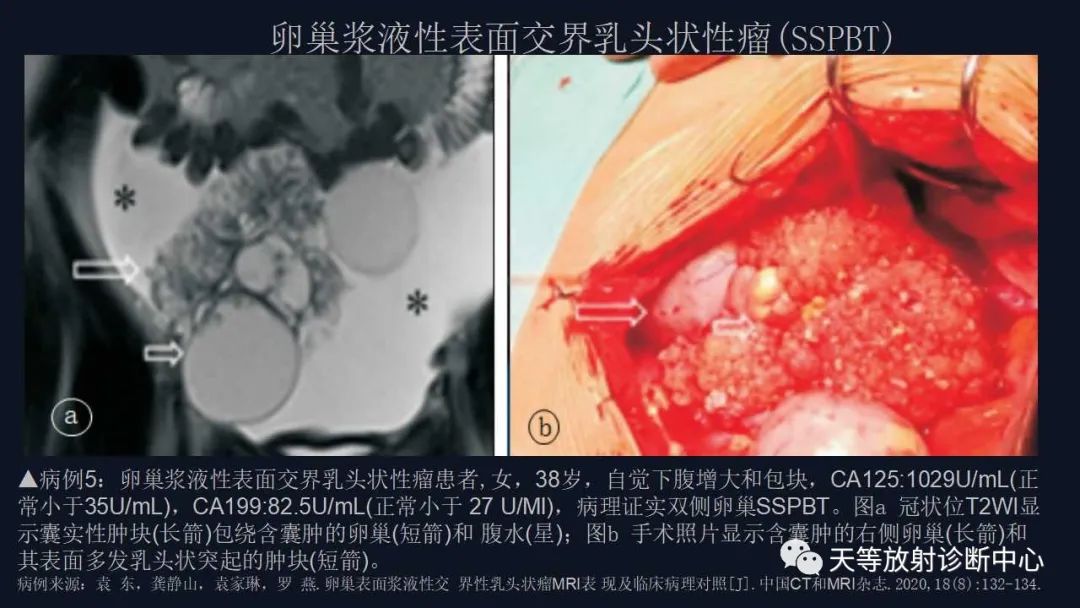 影像PPT - 【病例】卵巢囊腺瘤1例MR影像-31 影像PPT - 【病例】卵巢囊腺瘤1例MR影像-31