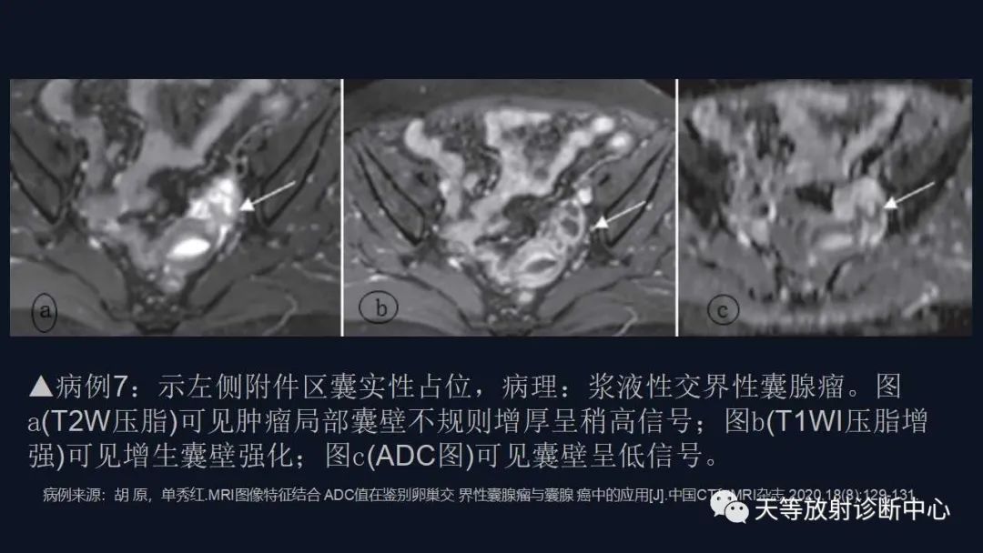 影像PPT - 【病例】卵巢囊腺瘤1例MR影像-34 影像PPT - 【病例】卵巢囊腺瘤1例MR影像-34