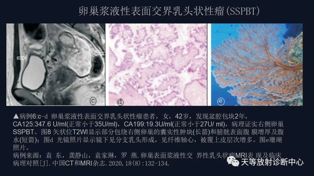 影像PPT - 【病例】卵巢囊腺瘤1例MR影像-32 影像PPT - 【病例】卵巢囊腺瘤1例MR影像-32