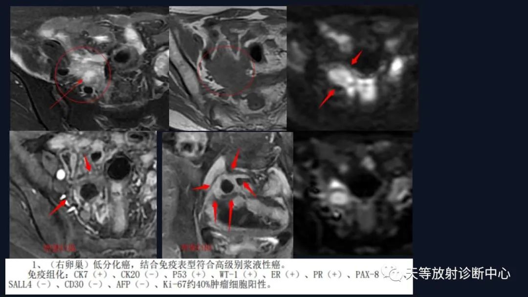 影像PPT - 【病例】卵巢囊腺瘤1例MR影像-37 影像PPT - 【病例】卵巢囊腺瘤1例MR影像-37