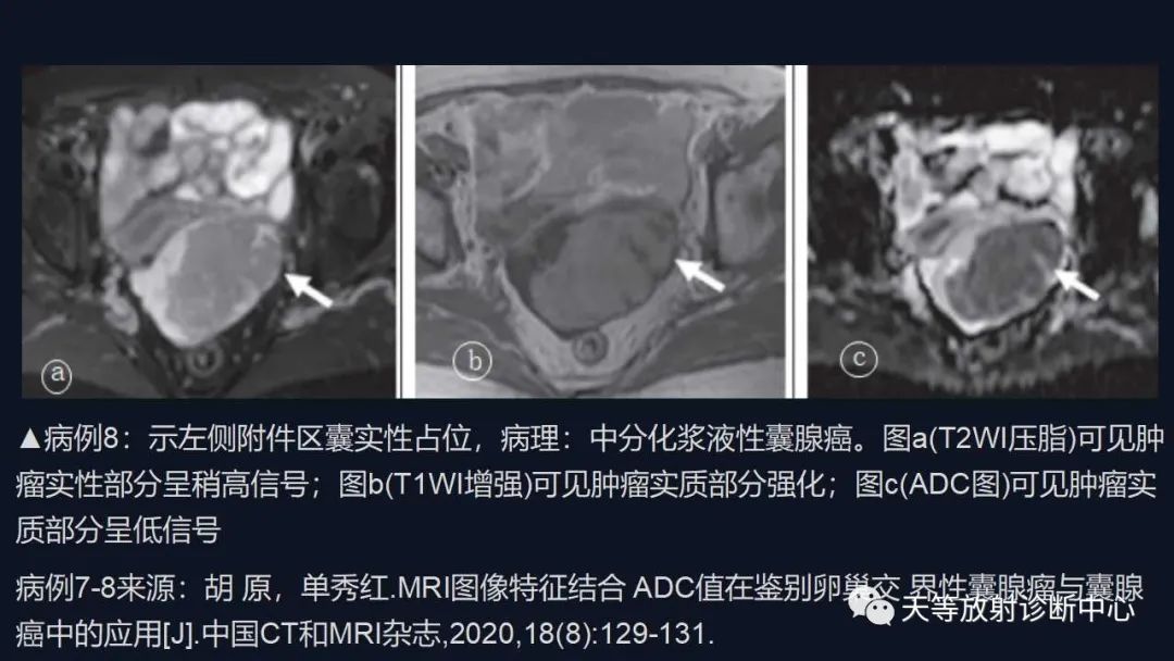 影像PPT - 【病例】卵巢囊腺瘤1例MR影像-36 影像PPT - 【病例】卵巢囊腺瘤1例MR影像-36