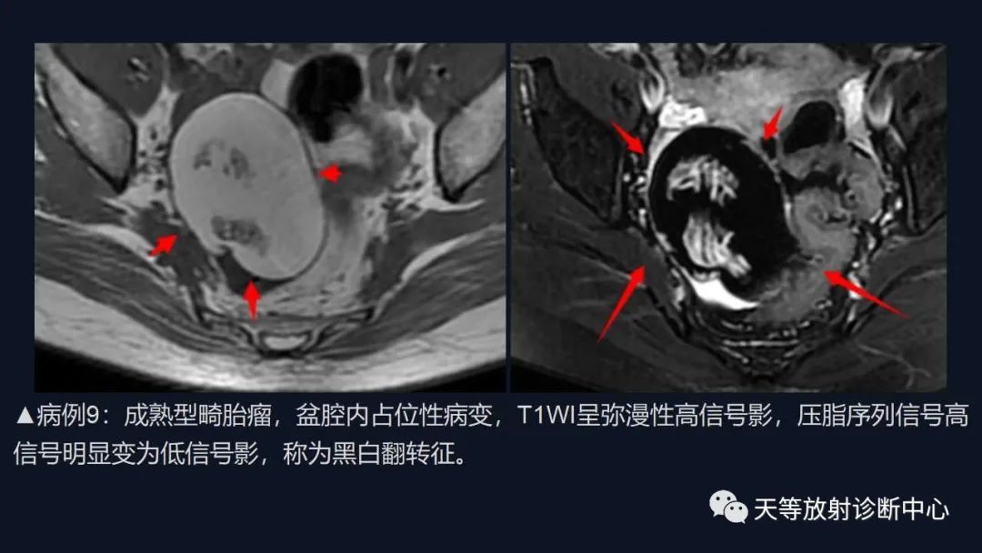 影像PPT - 【病例】卵巢囊腺瘤1例MR影像-41 影像PPT - 【病例】卵巢囊腺瘤1例MR影像-41