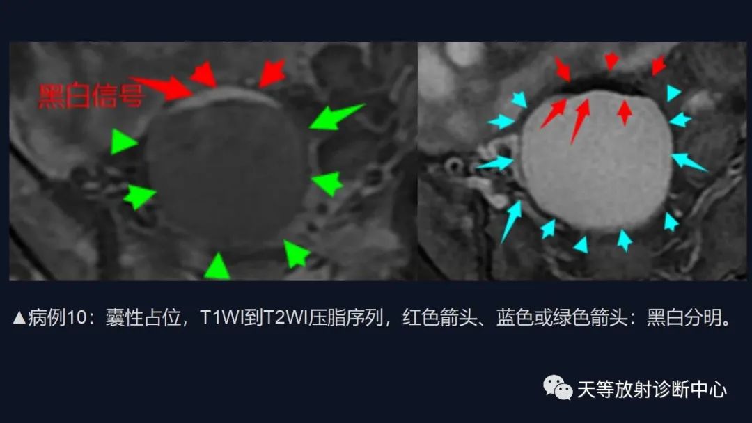 影像PPT - 【病例】卵巢囊腺瘤1例MR影像-42 影像PPT - 【病例】卵巢囊腺瘤1例MR影像-42