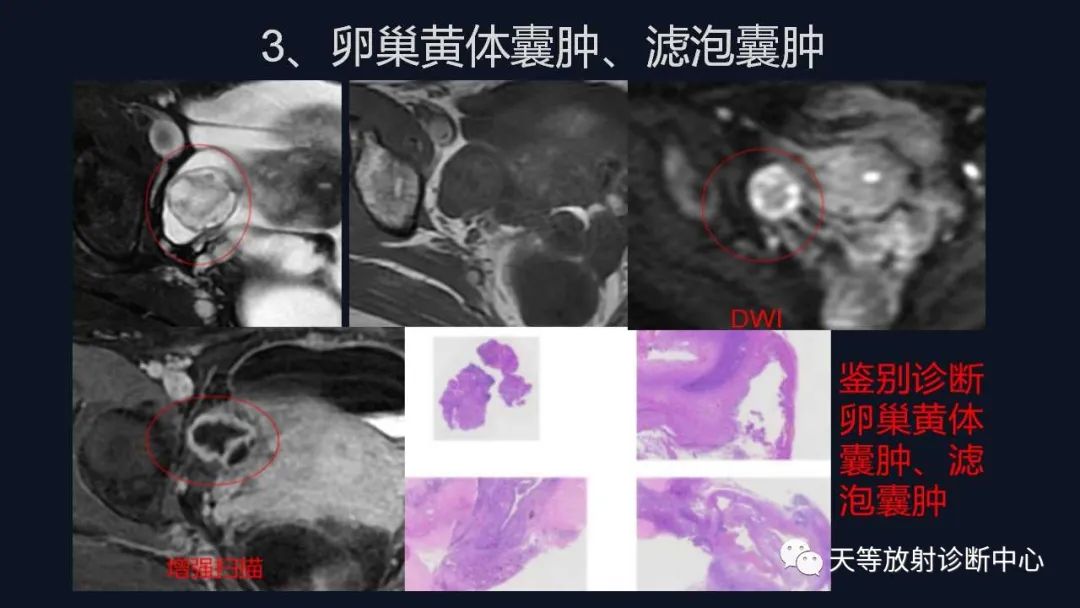 影像PPT - 【病例】卵巢囊腺瘤1例MR影像-43 影像PPT - 【病例】卵巢囊腺瘤1例MR影像-43