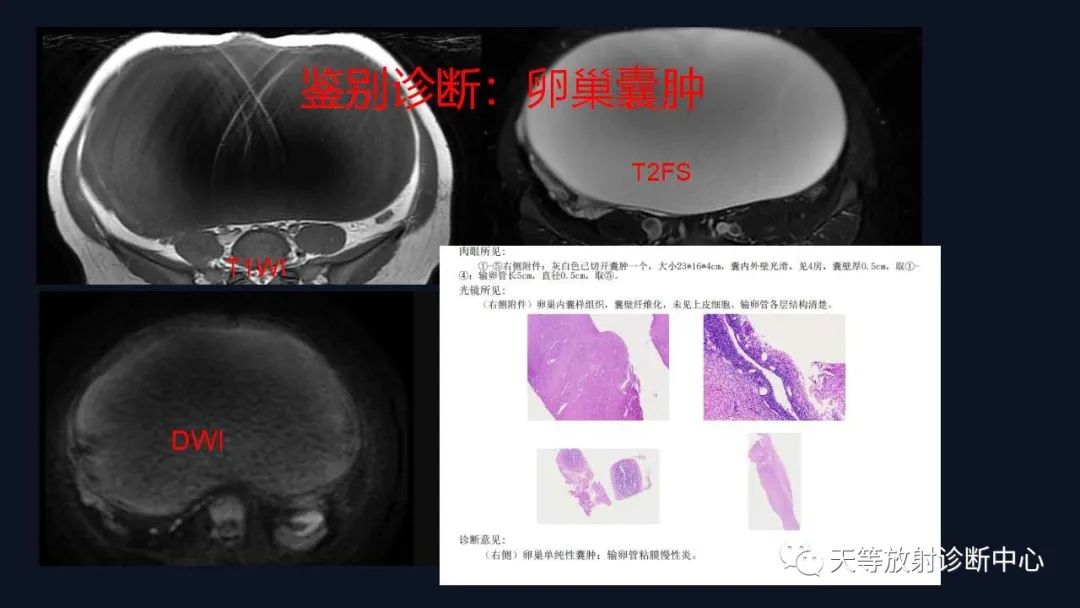 影像PPT - 【病例】卵巢囊腺瘤1例MR影像-44 影像PPT - 【病例】卵巢囊腺瘤1例MR影像-44