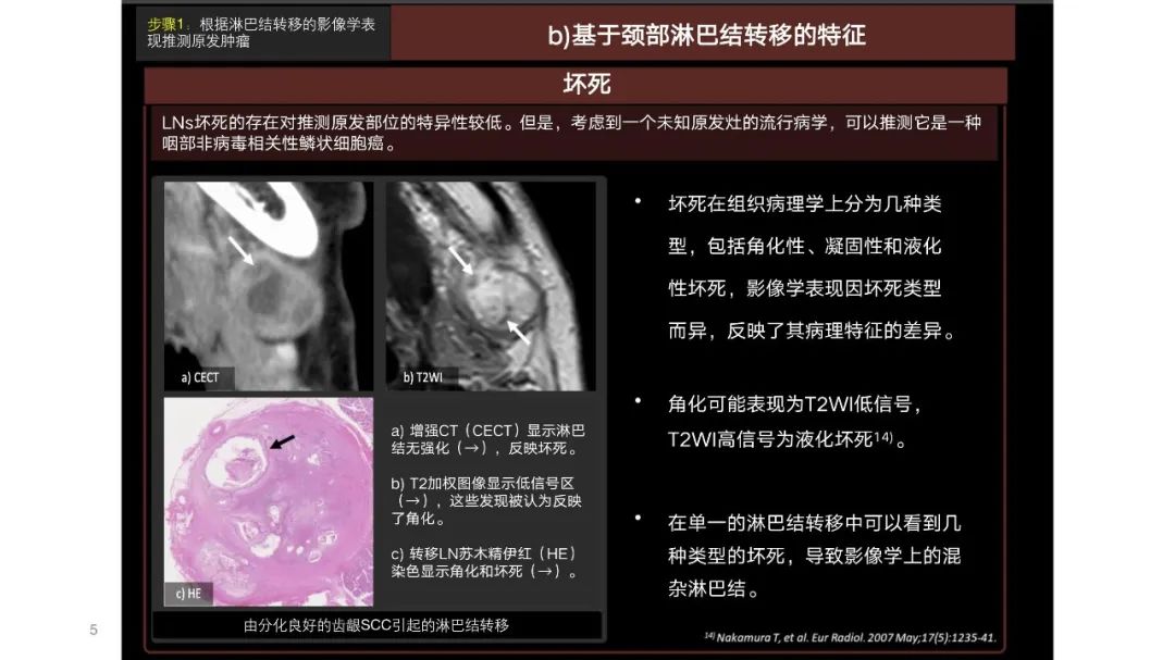 影像PPT - 【PPT】原发肿瘤在哪里？不明原发肿瘤颈部淋巴结转移的影像学检查方法-3