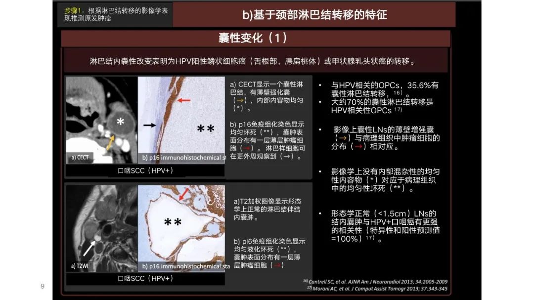 影像PPT - 【PPT】原发肿瘤在哪里？不明原发肿瘤颈部淋巴结转移的影像学检查方法-7