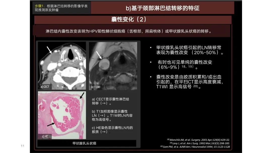 影像PPT - 【PPT】原发肿瘤在哪里？不明原发肿瘤颈部淋巴结转移的影像学检查方法-9