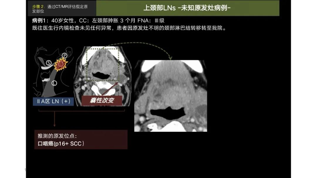 影像PPT - 【PPT】原发肿瘤在哪里？不明原发肿瘤颈部淋巴结转移的影像学检查方法-15