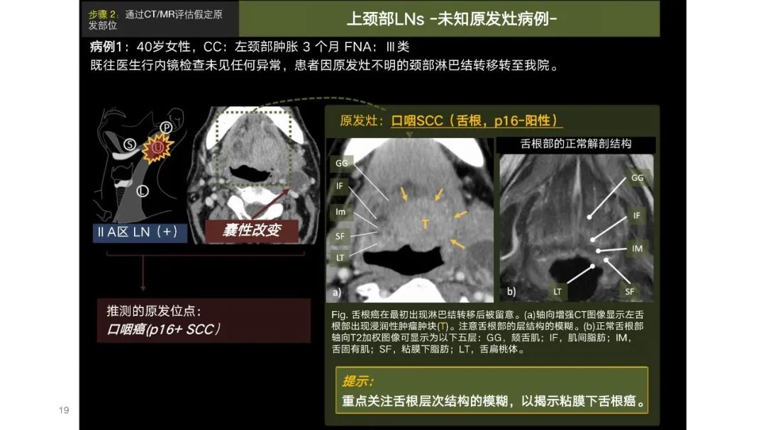 影像PPT - 【PPT】原发肿瘤在哪里？不明原发肿瘤颈部淋巴结转移的影像学检查方法-17