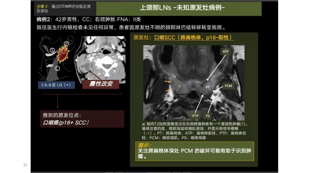 影像PPT - 【PPT】原发肿瘤在哪里？不明原发肿瘤颈部淋巴结转移的影像学检查方法-19