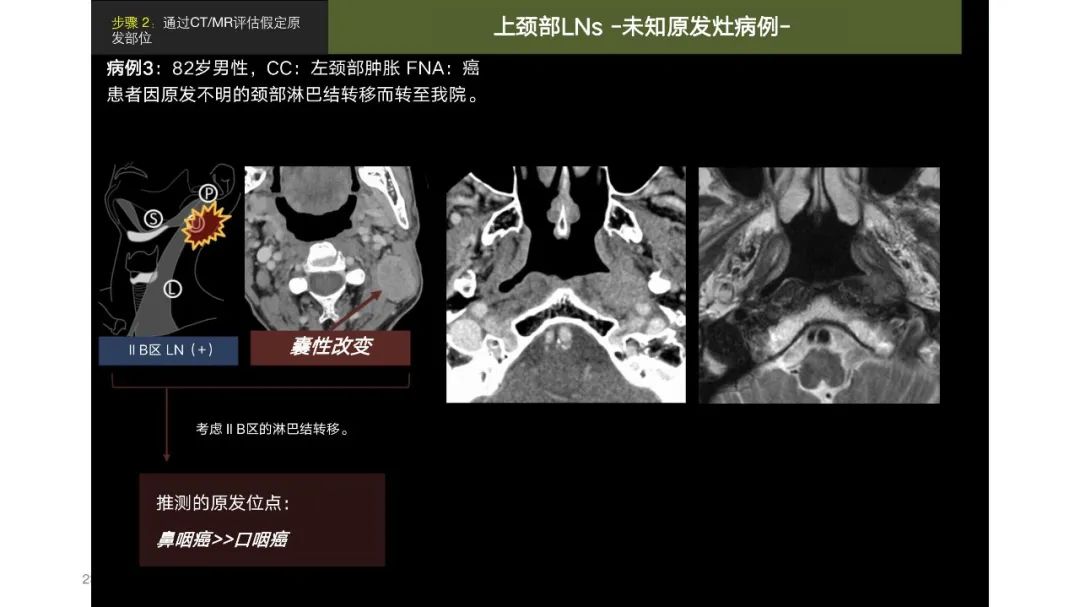 影像PPT - 【PPT】原发肿瘤在哪里？不明原发肿瘤颈部淋巴结转移的影像学检查方法-21