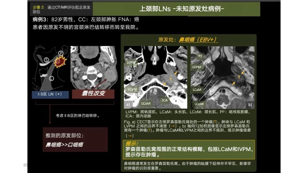影像PPT - 【PPT】原发肿瘤在哪里？不明原发肿瘤颈部淋巴结转移的影像学检查方法-23